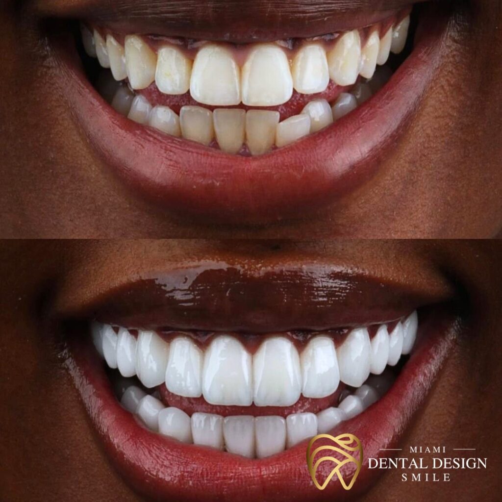 Dental Design Smile Miami - Before and After