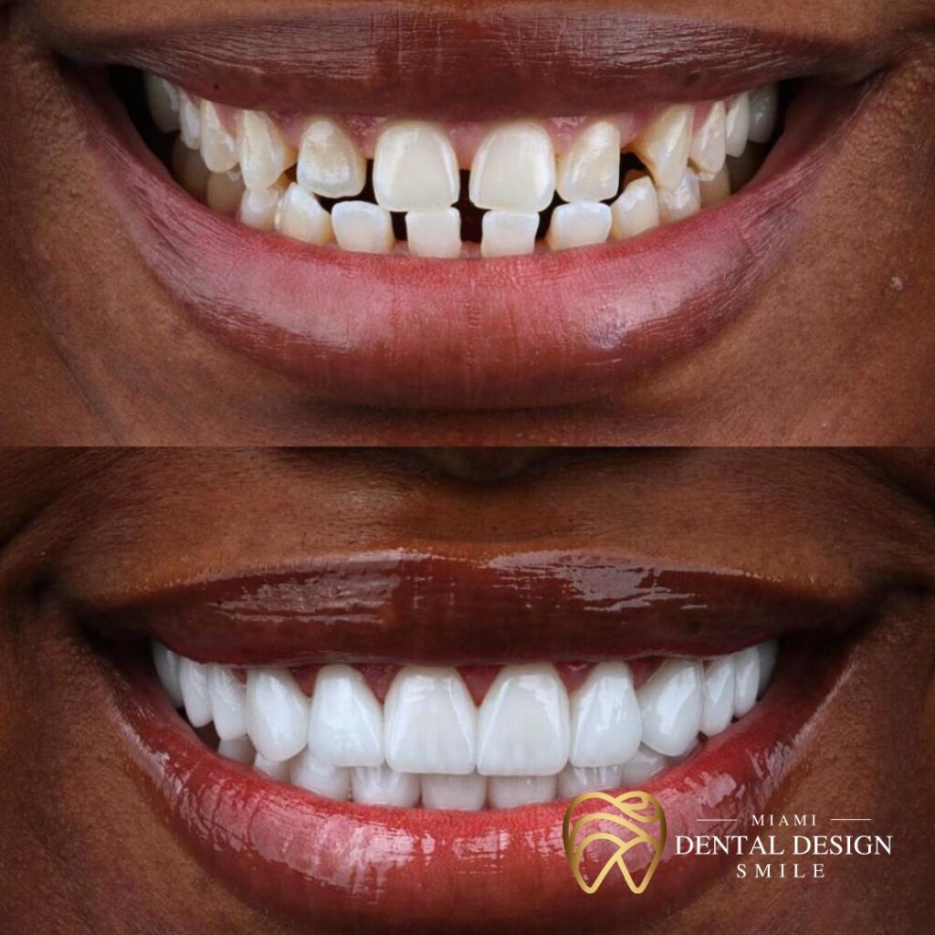 Dental Design Smile Miami - Before and After Home 2