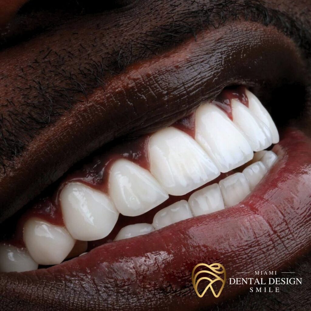 Porcelain Veneers in Miami - Dental Design Smile Miami 2