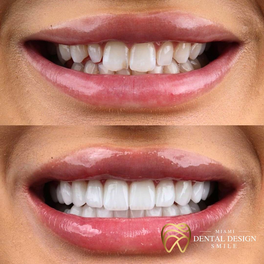 Get 1000 OFF on Porcelain Veneers Miami Dental Design Smile Miami