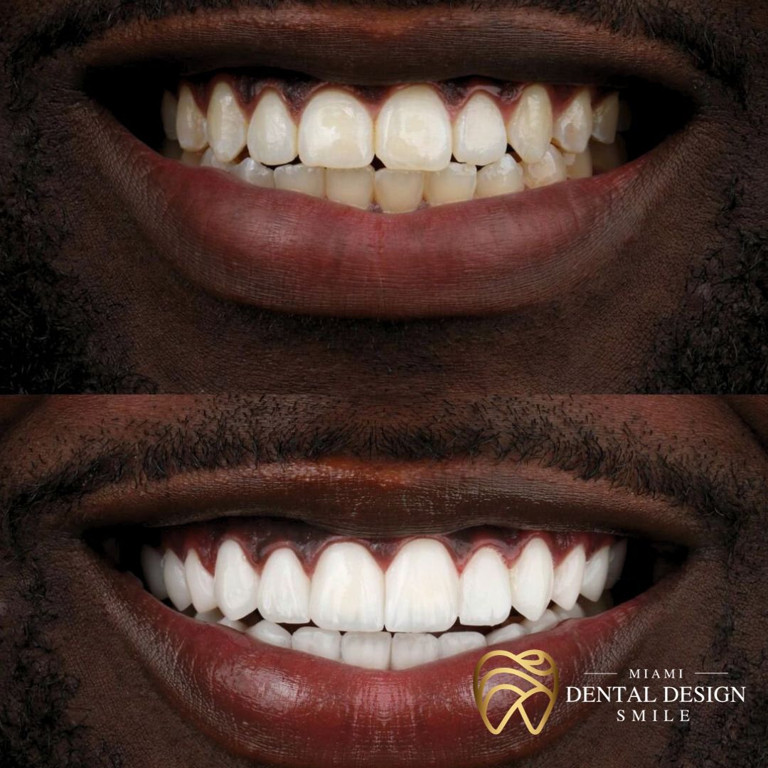 What are dental veneers? - Dental Design Smile