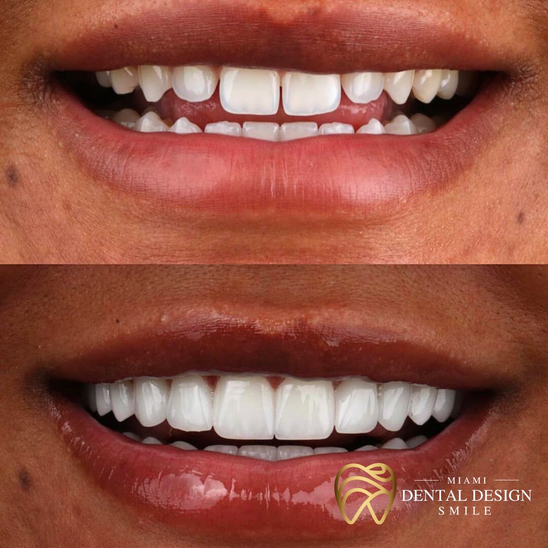 Get 1000 OFF on Porcelain Veneers Miami Dental Design Smile Miami