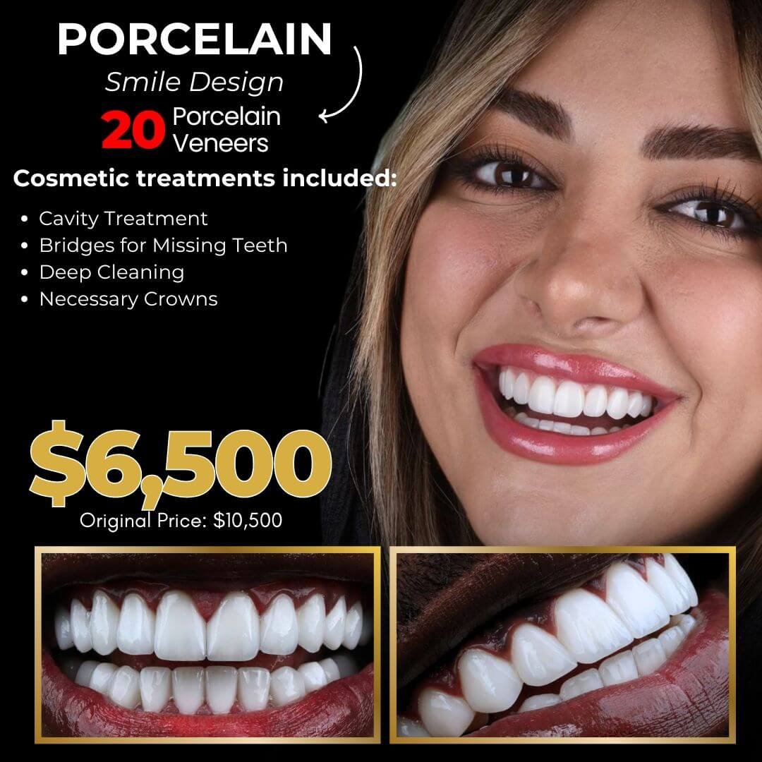 Porcelain Veneers Ads - Porcelain Veneers